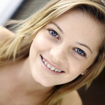 clear braces